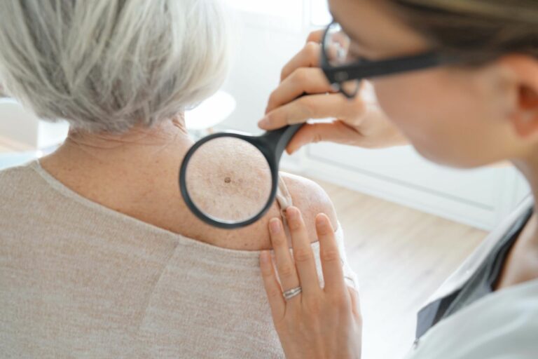 prevencion-cancer-de-piel 65ymas
